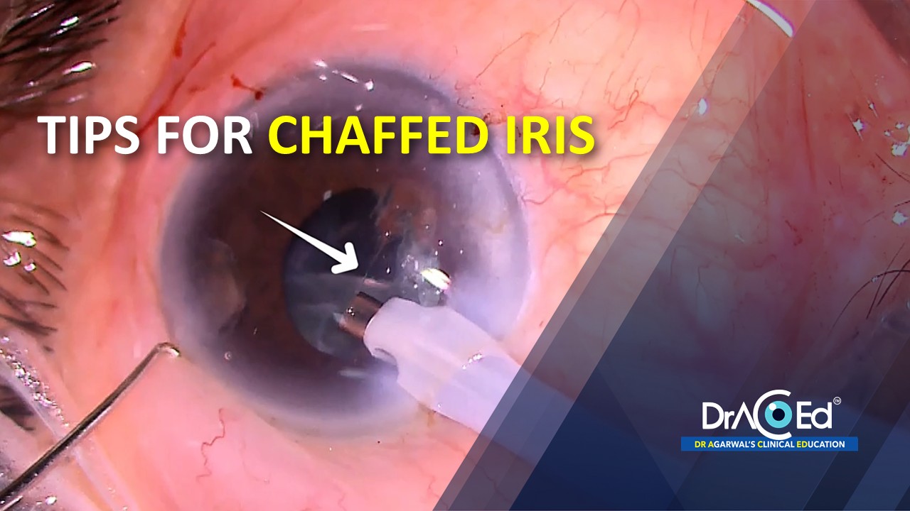 TIPS FOR CHAFFED IRIS